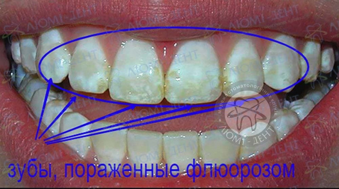 Флюороз зубов эмали фото Люми-Дент